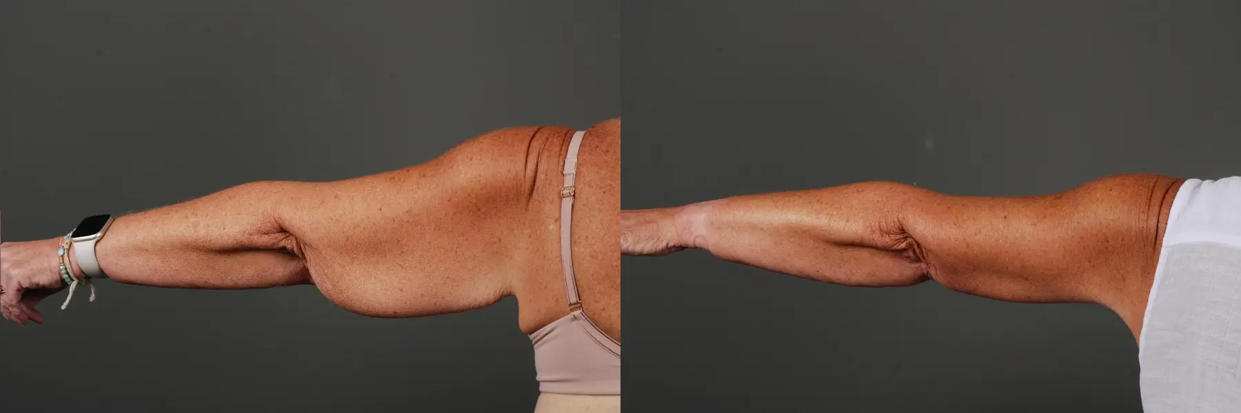 Arm Lift: Patient 4 - Before and After 2