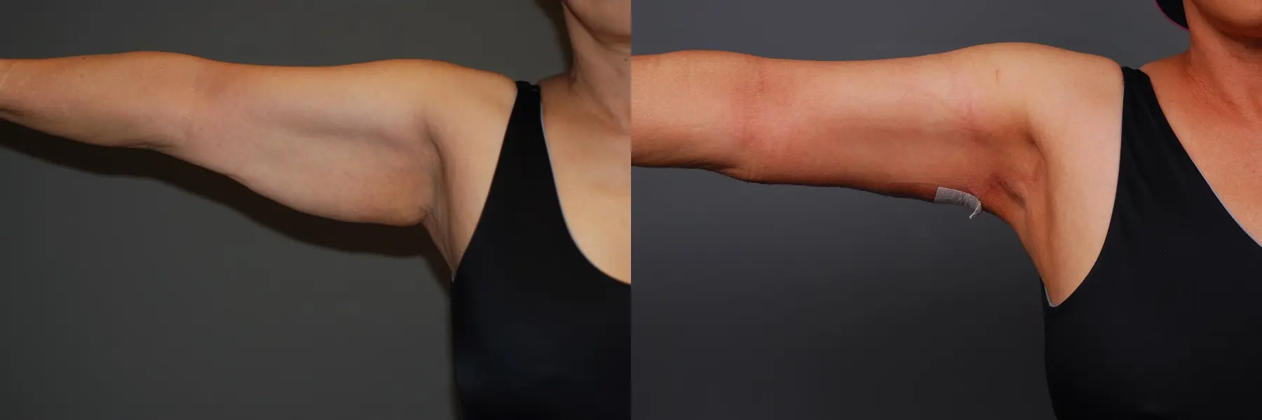 Arm Lift: Patient 2 - Before and After 4