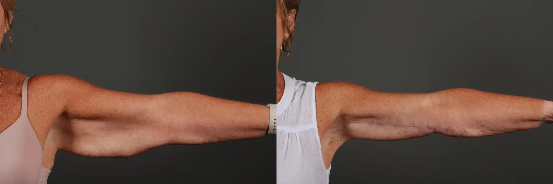 Arm Lift: Patient 4 - Before and After 1