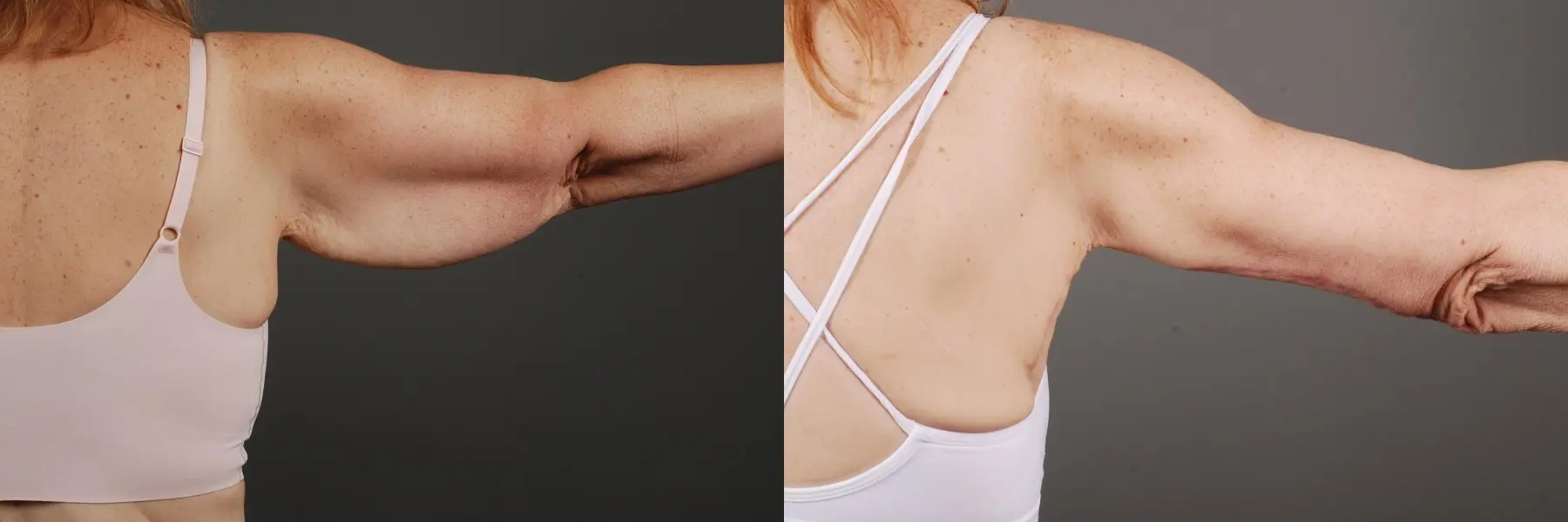 Arm Lift: Patient 3 - Before and After 1