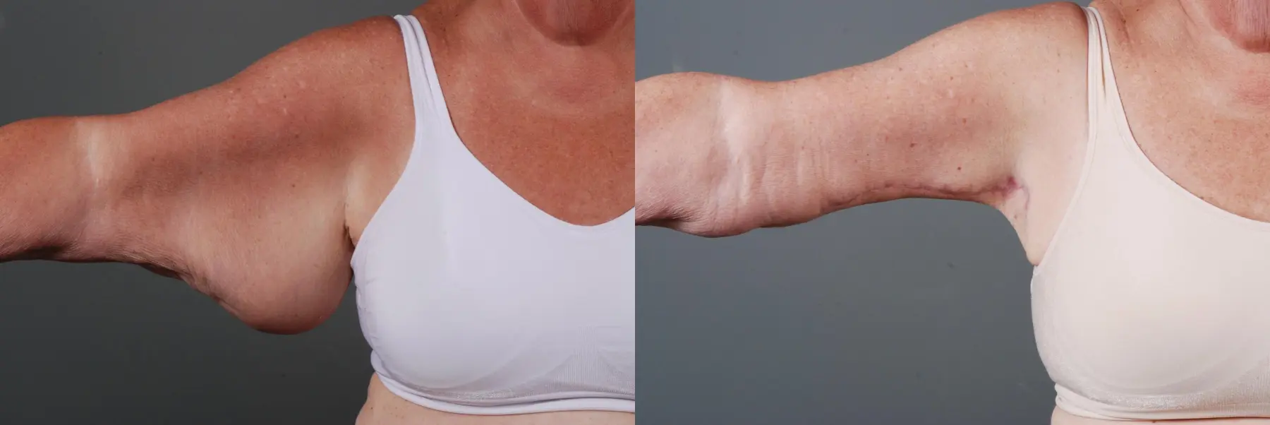 Arm Lift: Patient 1 - Before and After 4