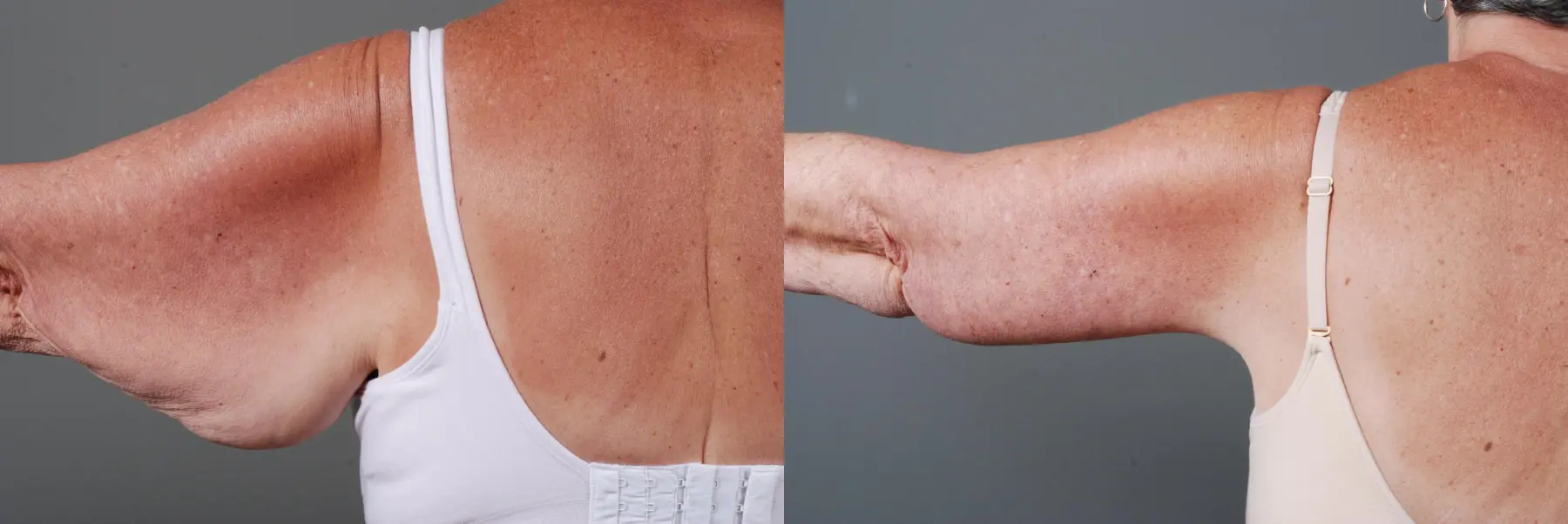 Arm Lift: Patient 1 - Before and After 2
