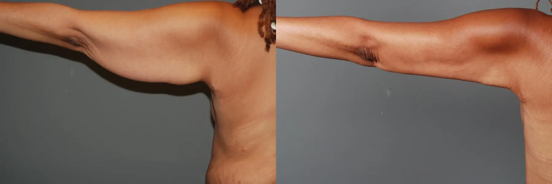 Arm Lift: Patient 5 - Before and After 2