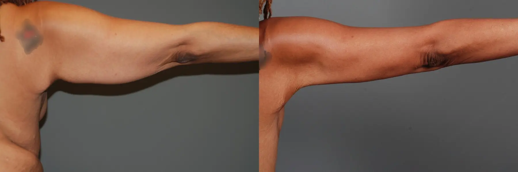 Arm Lift: Patient 5 - Before and After 1