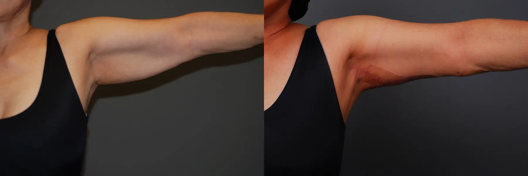 Arm Lift: Patient 2 - Before and After 2
