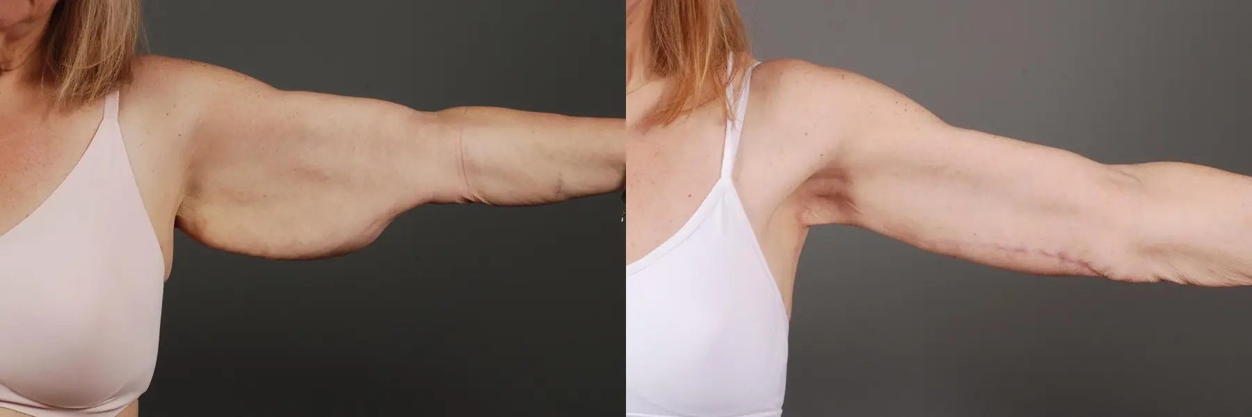 Arm Lift: Patient 3 - Before and After 4