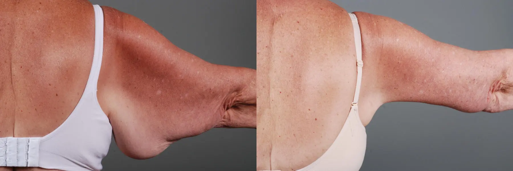 Arm Lift: Patient 1 - Before and After 1