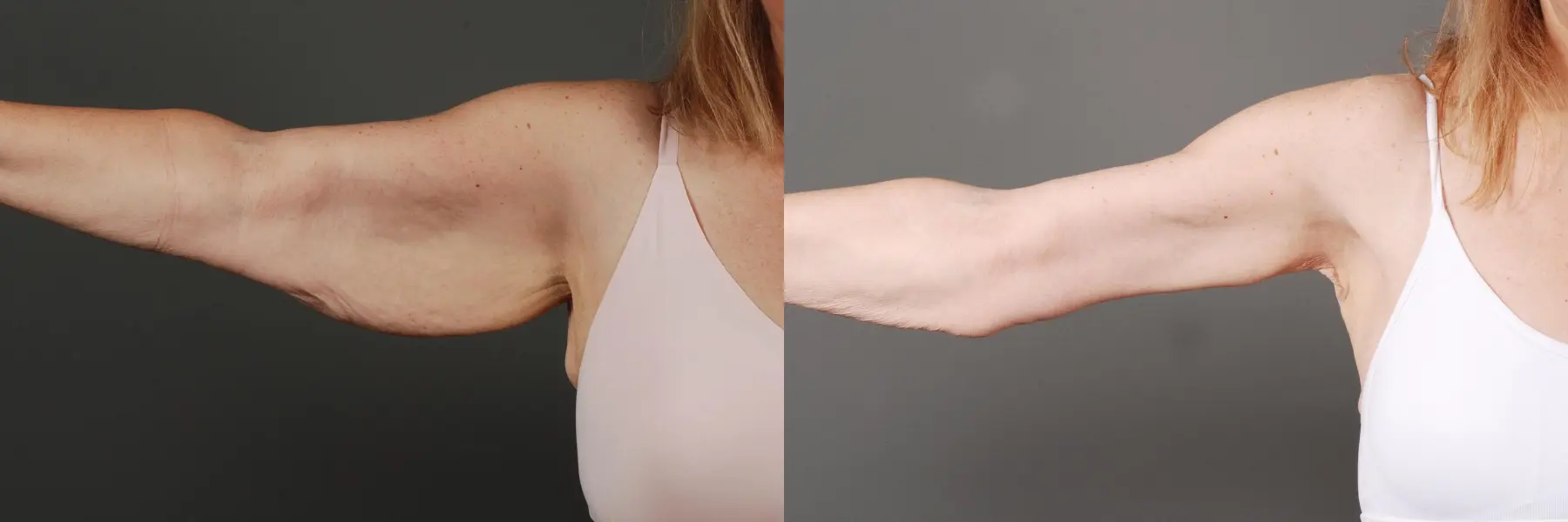 Arm Lift: Patient 3 - Before and After 3