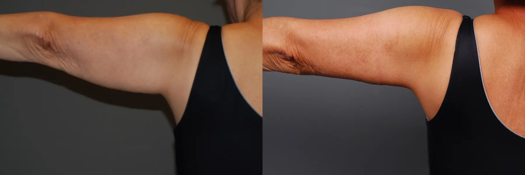 Arm Lift: Patient 2 - Before and After 3