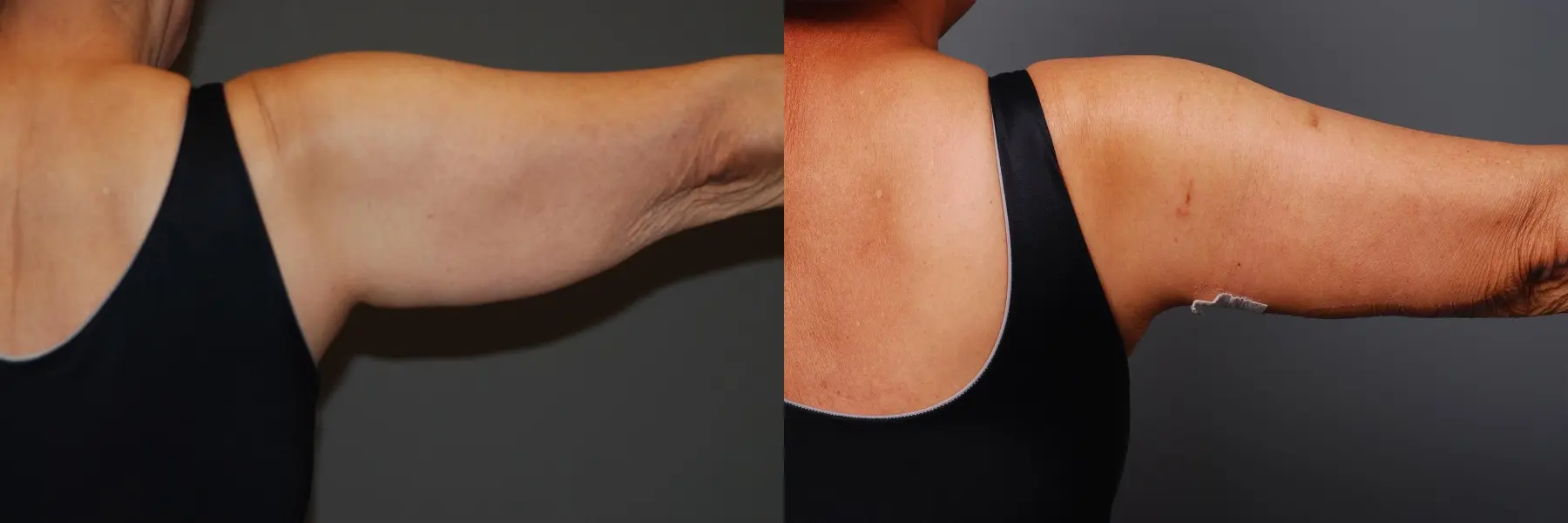 Arm Lift: Patient 2 - Before and After 1