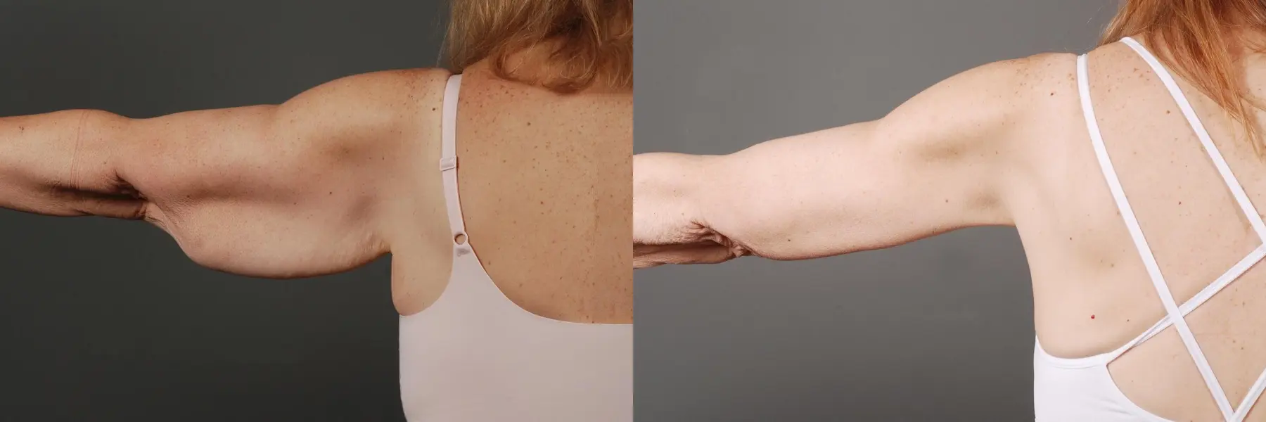 Arm Lift: Patient 3 - Before and After 2