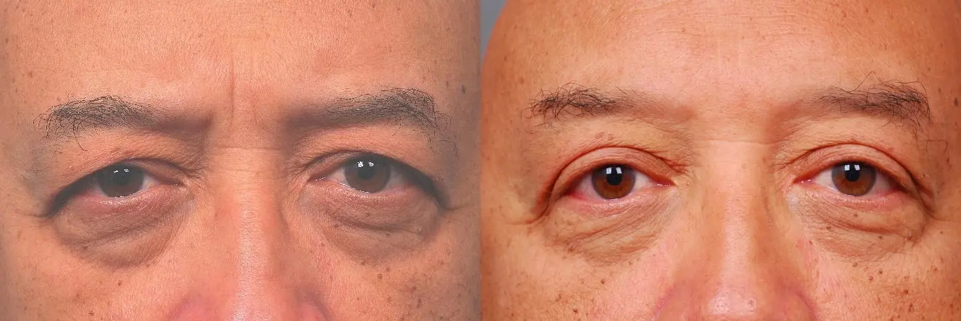 Blepharoplasty: Patient 2 - Before and After 1