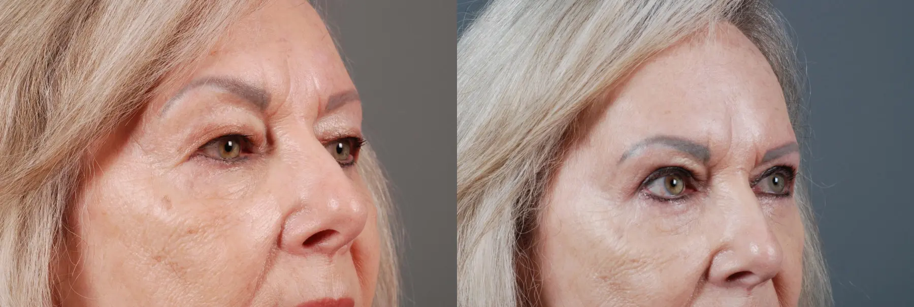 Blepharoplasty: Patient 1 - Before and After 2