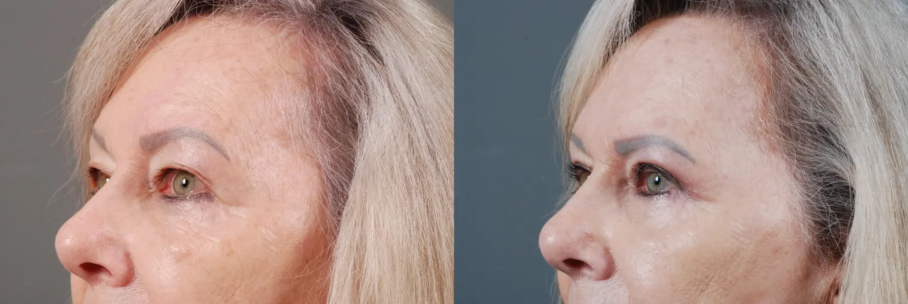 Blepharoplasty: Patient 1 - Before and After 3