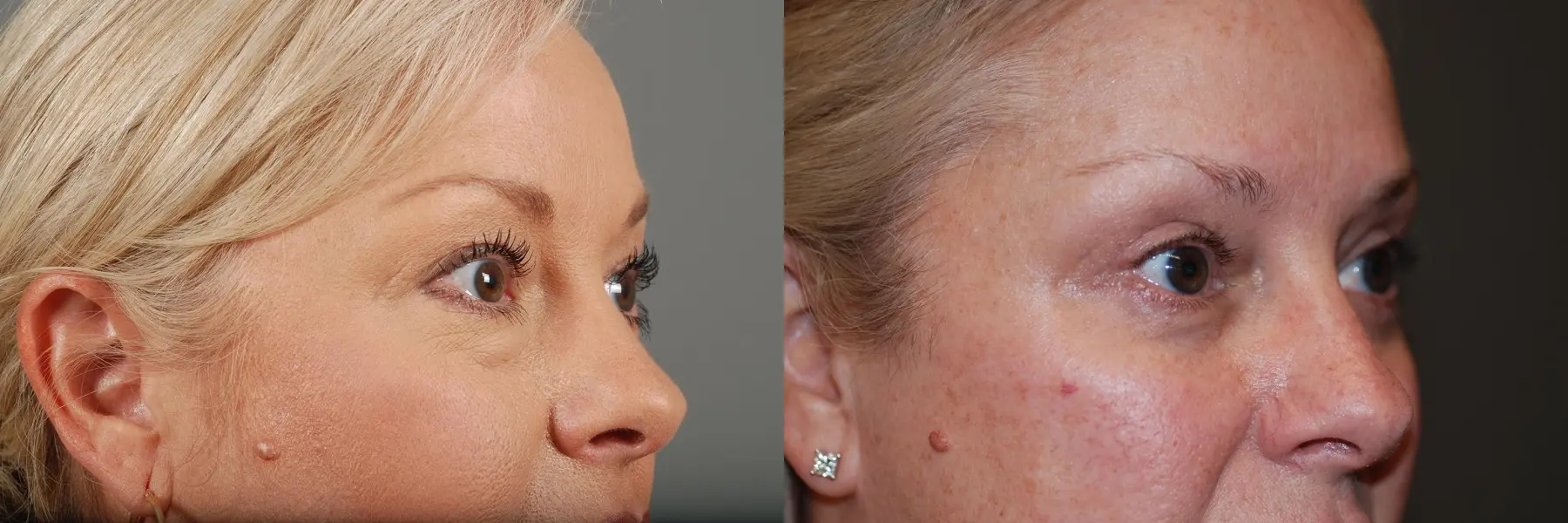 Blepharoplasty: Patient 3 - Before and After 5