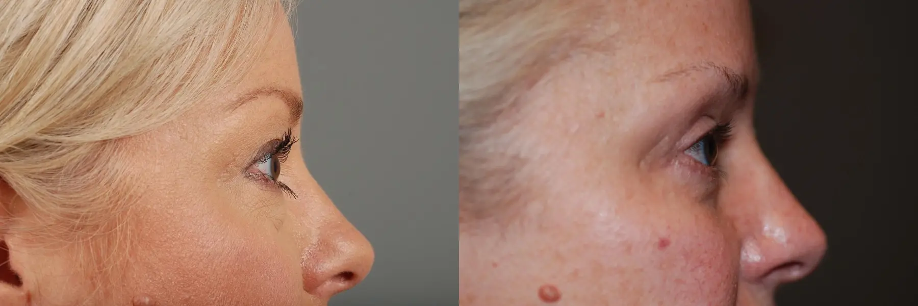 Blepharoplasty: Patient 3 - Before and After 3