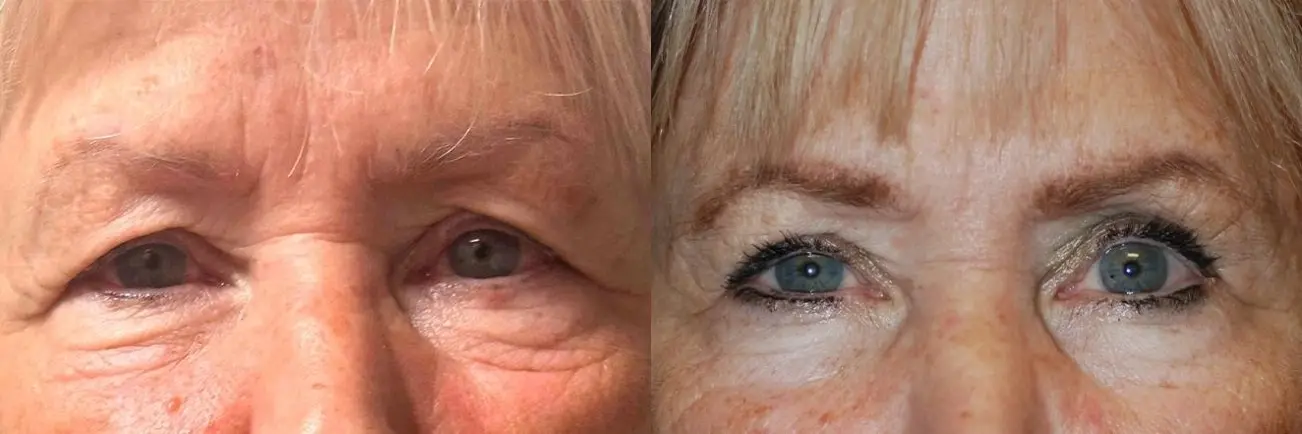 Blepharoplasty: Patient 4 - Before and After 1