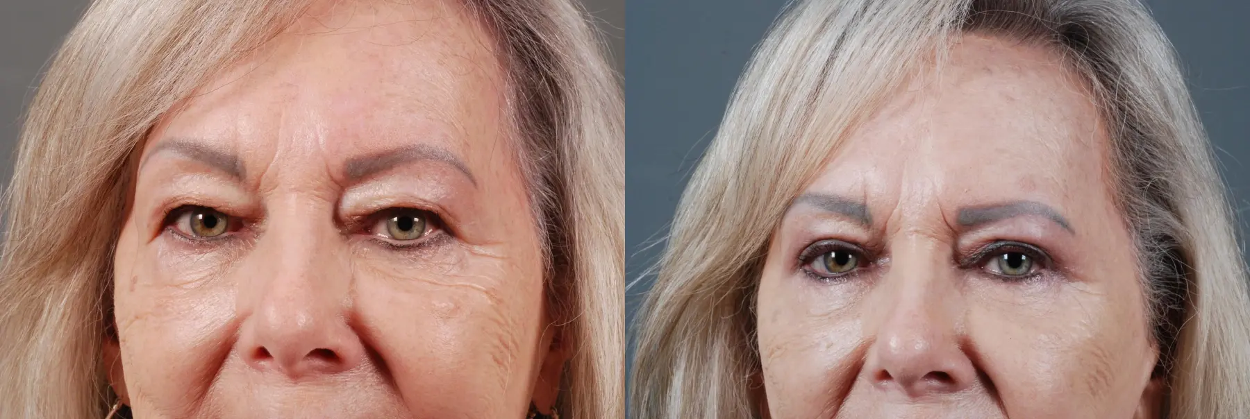 Blepharoplasty: Patient 1 - Before and After 1