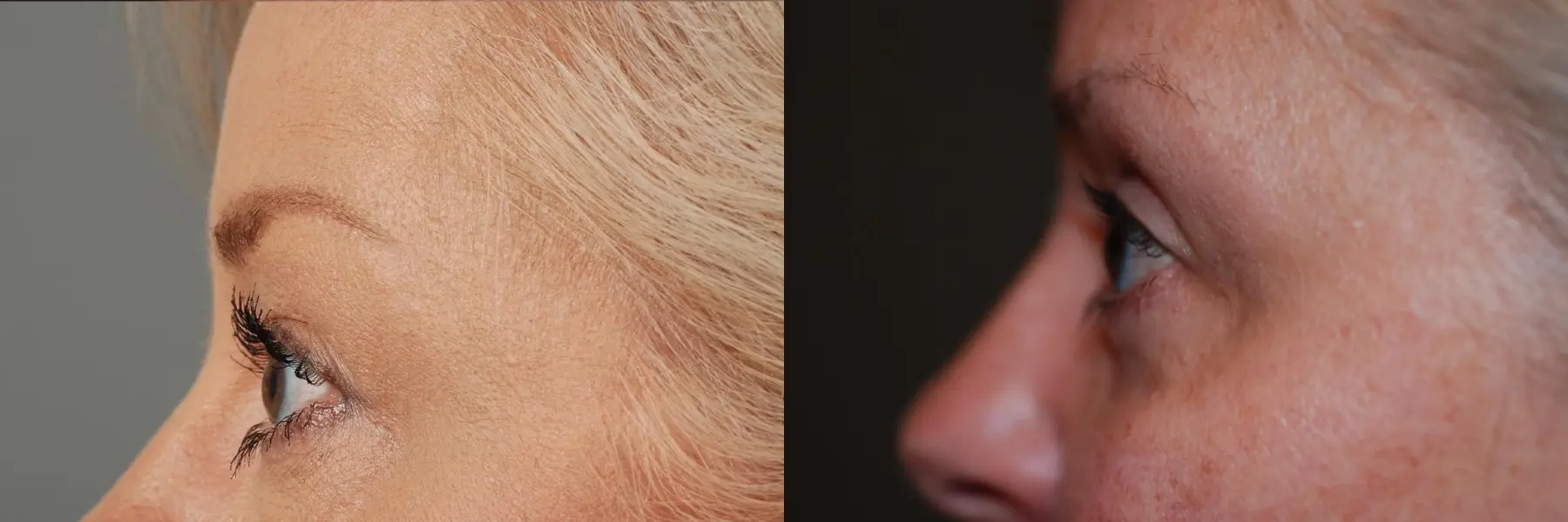 Blepharoplasty: Patient 3 - Before and After 1