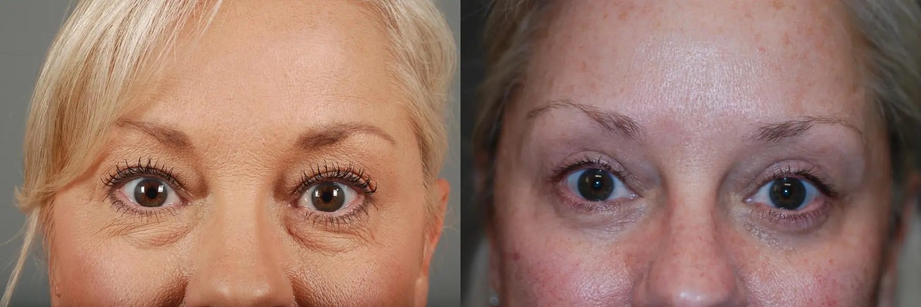 Blepharoplasty: Patient 3 - Before and After 4