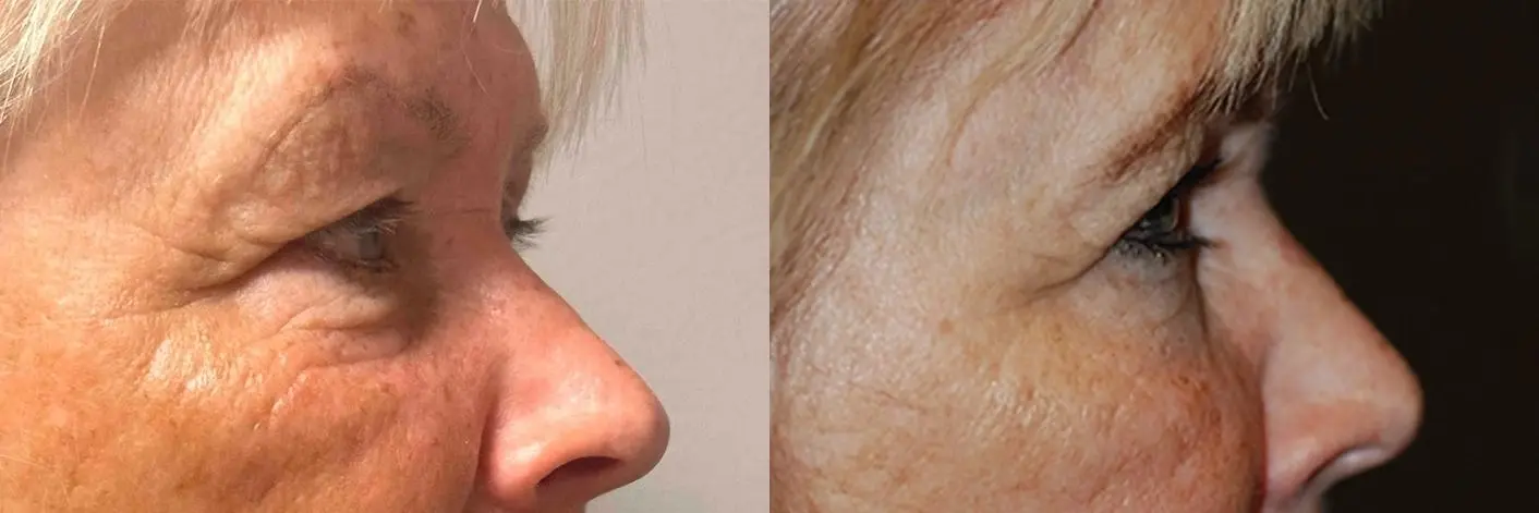 Blepharoplasty: Patient 4 - Before and After 2