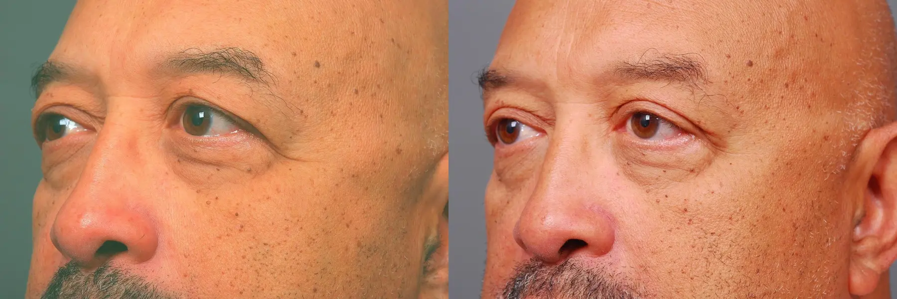 Blepharoplasty: Patient 2 - Before and After 2