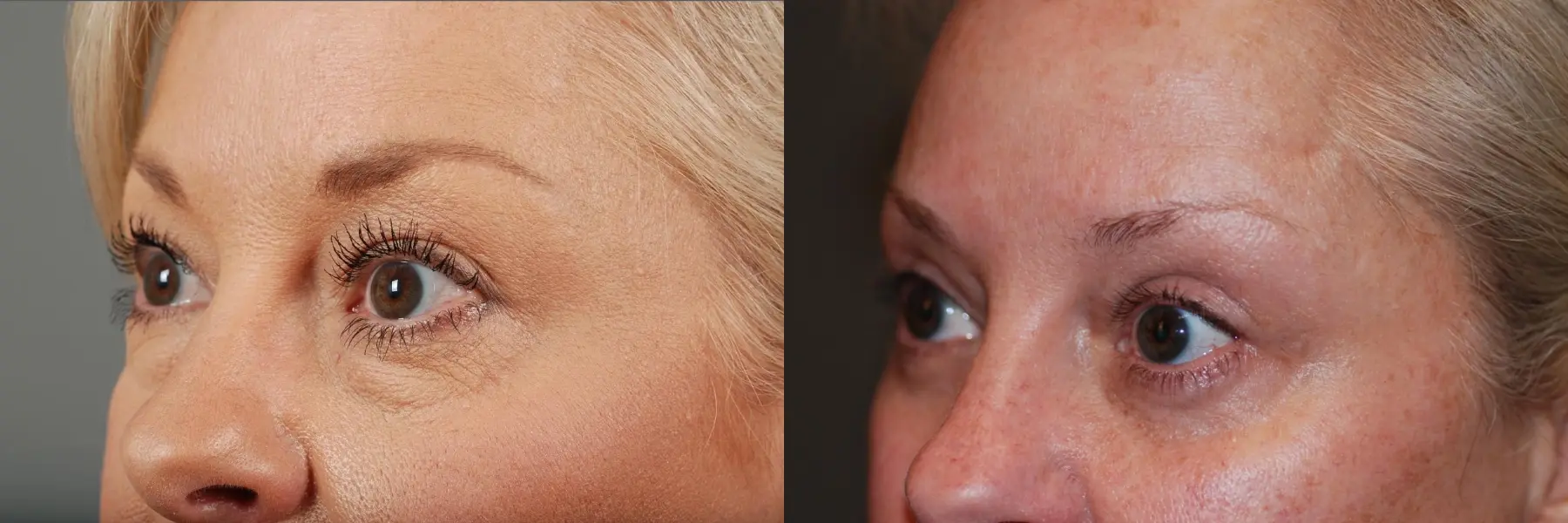 Blepharoplasty: Patient 3 - Before and After 2