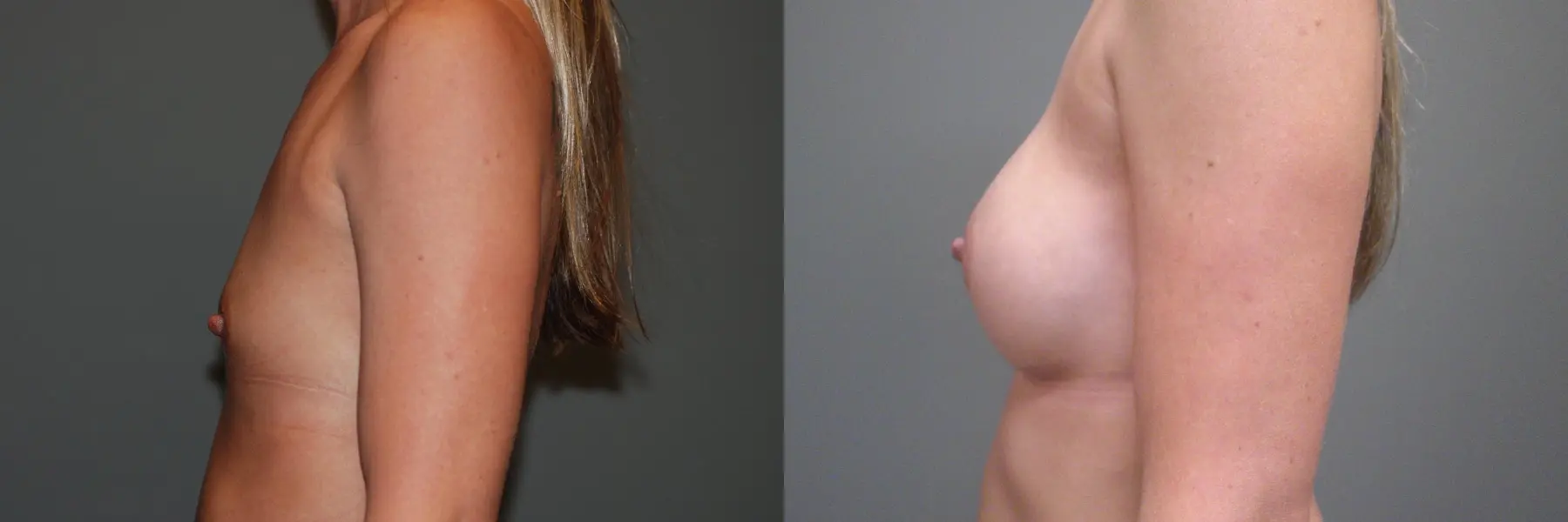 Breast Augmentation: Patient 3 - Before and After  