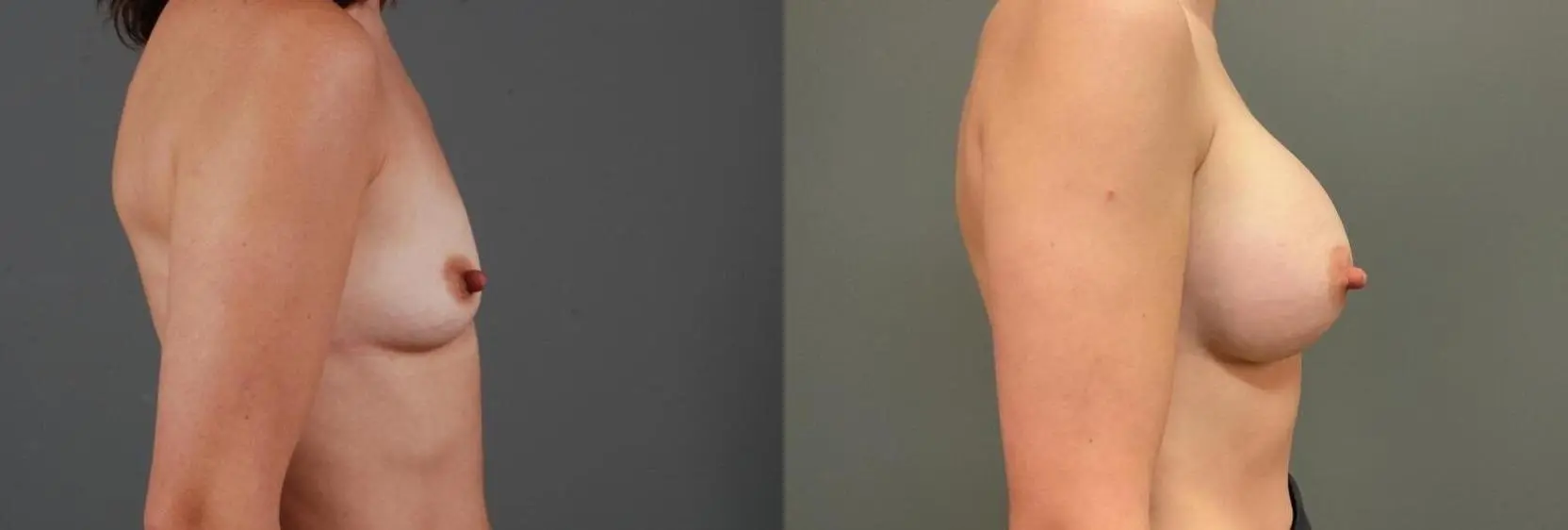 Breast Augmentation: Patient 5 - Before and After 4