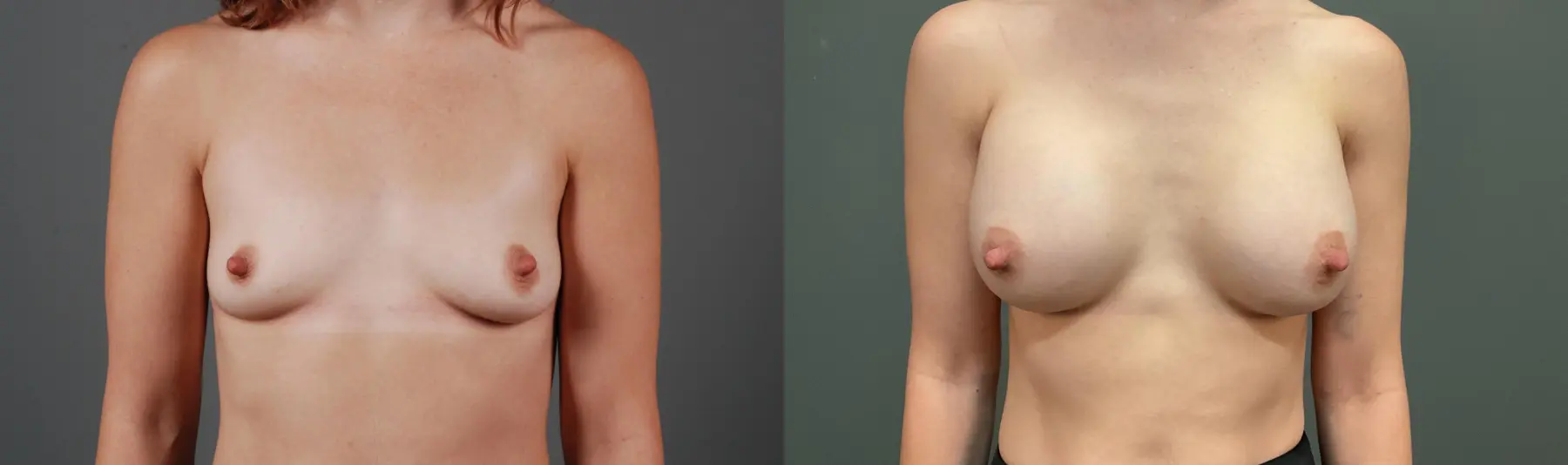 Breast Augmentation: Patient 5 - Before and After 1