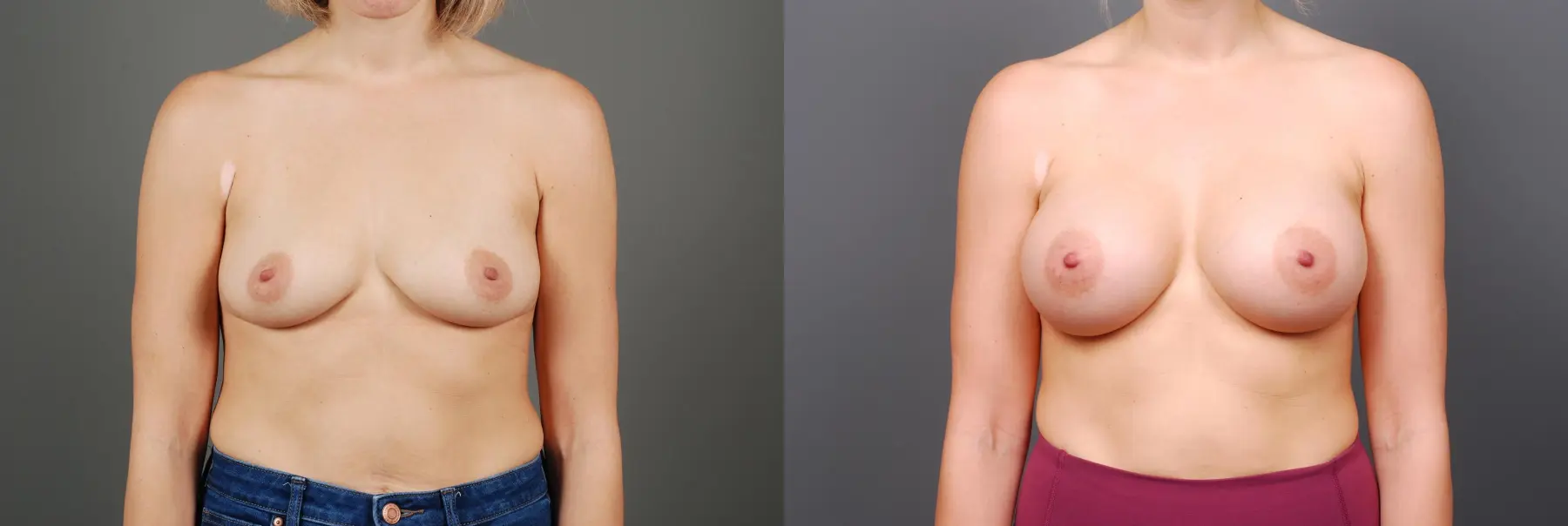 Breast Augmentation: Patient 4 - Before and After  