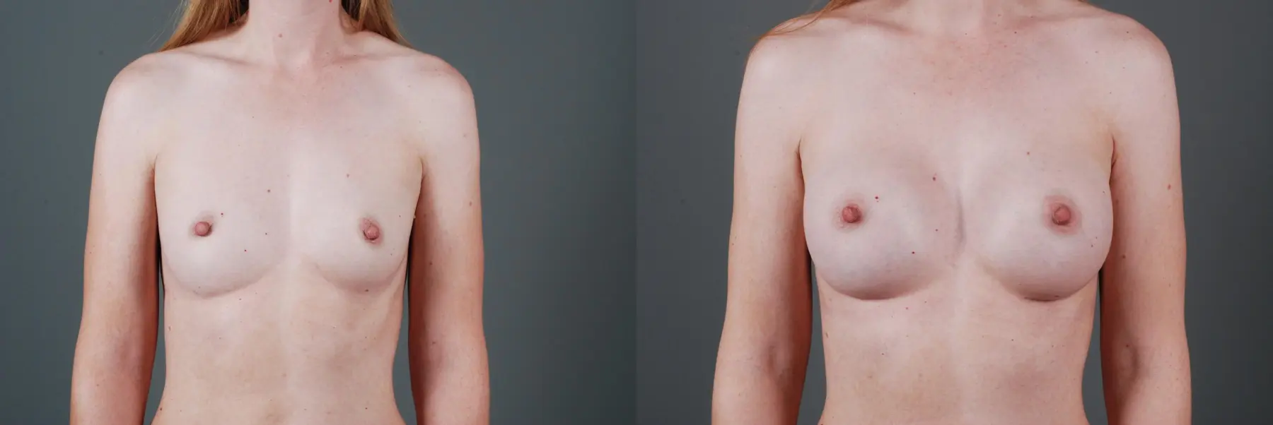 Breast Augmentation: Patient 6 - Before and After  