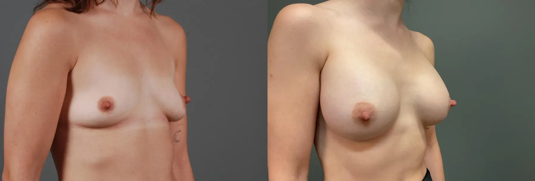 Breast Augmentation: Patient 5 - Before and After 3