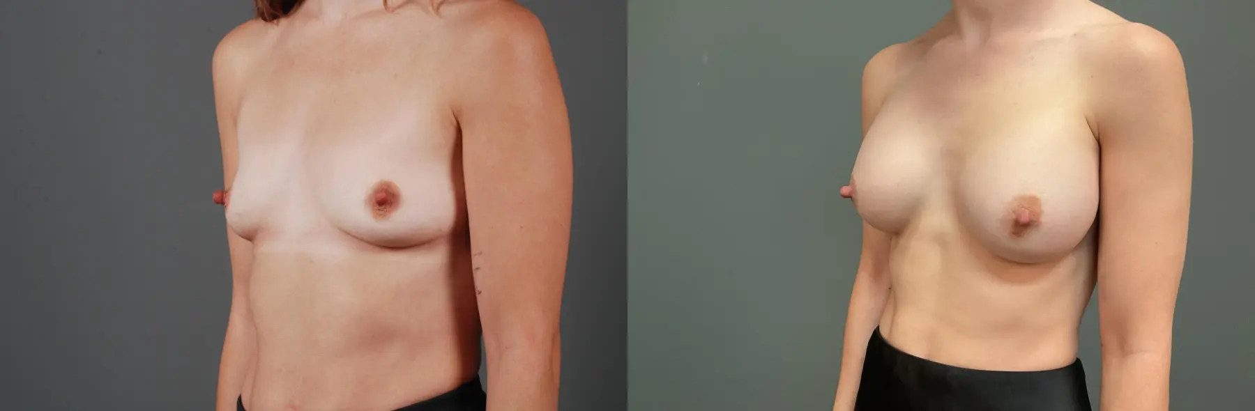Breast Augmentation: Patient 5 - Before and After 2