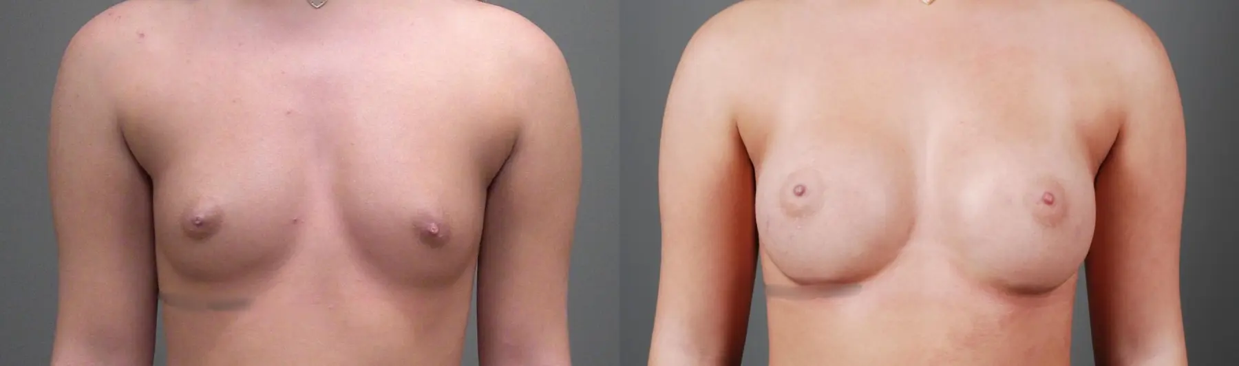 Breast Augmentation: Patient 1 - Before and After  