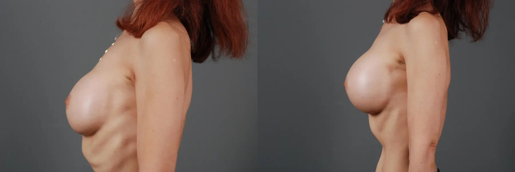 Breast Implant Exchange: Patient 4 - Before and After 2
