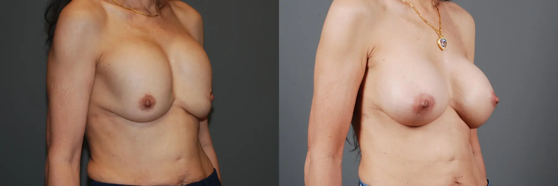 Breast Implant Exchange: Patient 7 - Before and After 2