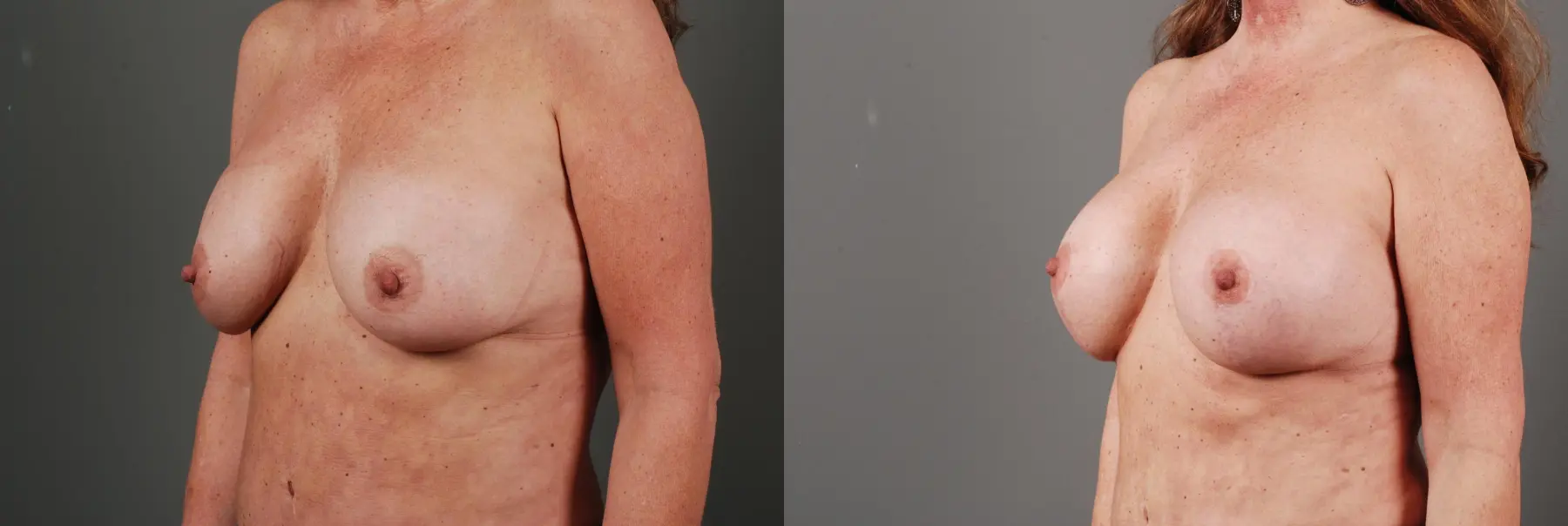 Breast Implant Exchange: Patient 2 - Before and After 2