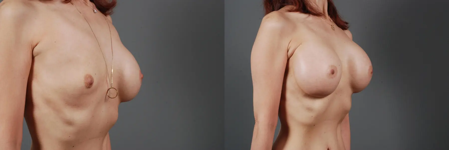 Breast Implant Exchange: Patient 4 - Before and After 4