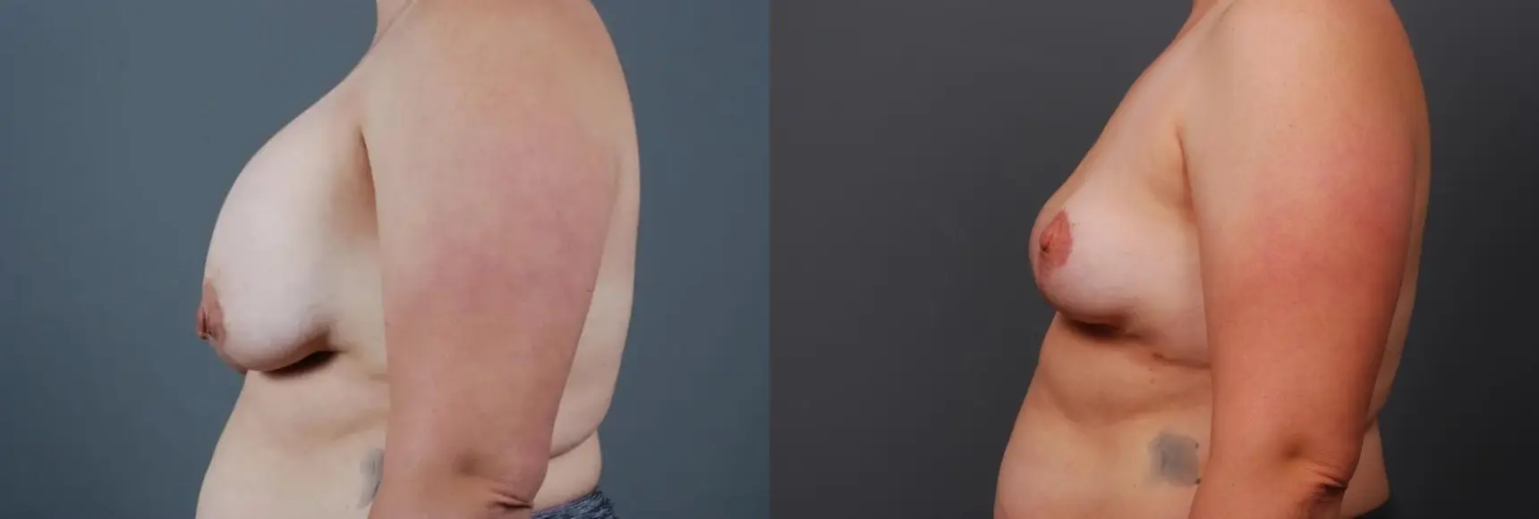 Breast Implant Exchange: Patient 6 - Before and After 2