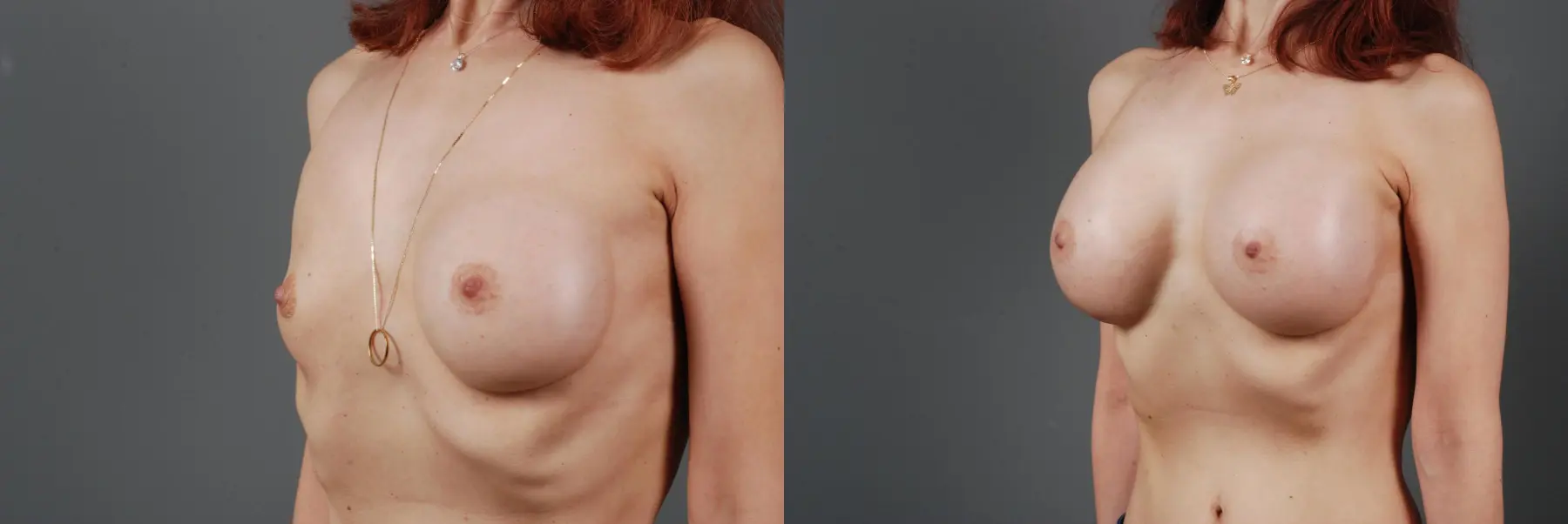Breast Implant Exchange: Patient 4 - Before and After 3