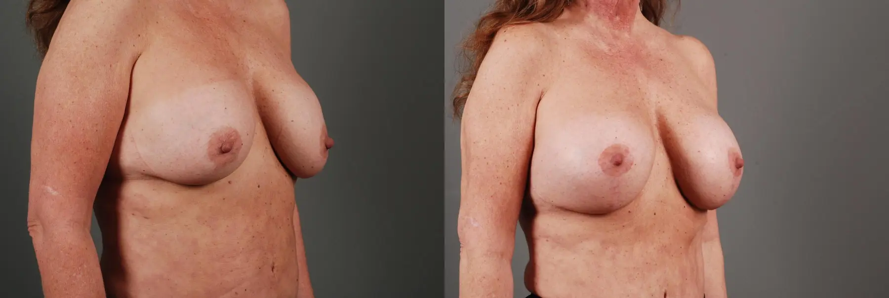 Breast Implant Exchange: Patient 2 - Before and After 3