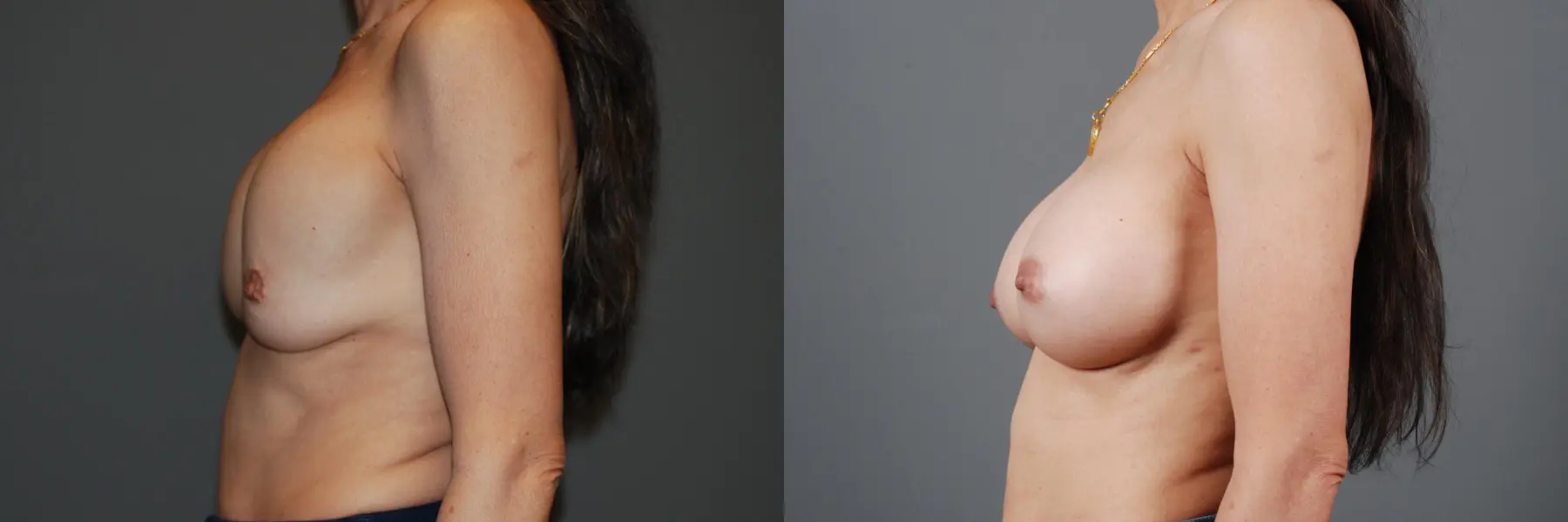 Breast Implant Exchange: Patient 7 - Before and After 5