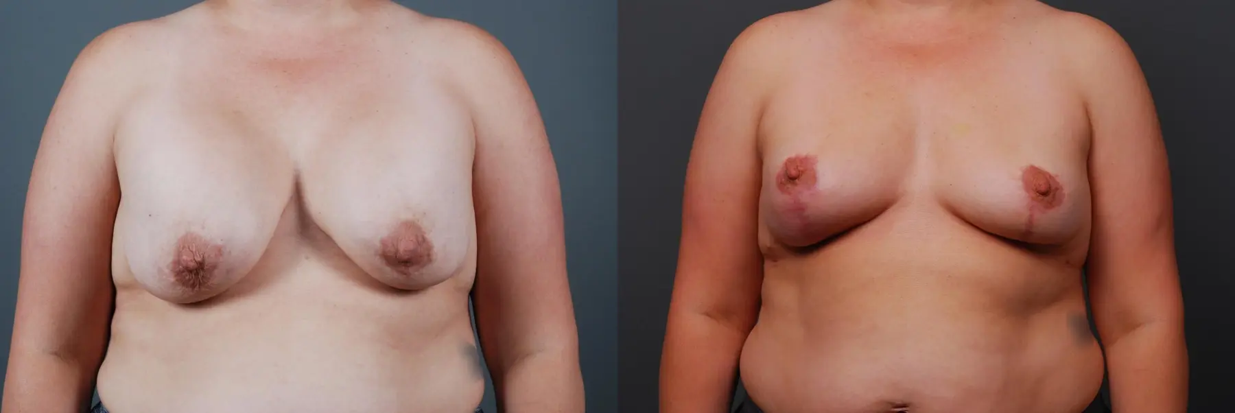 Breast Implant Exchange: Patient 6 - Before and After 1