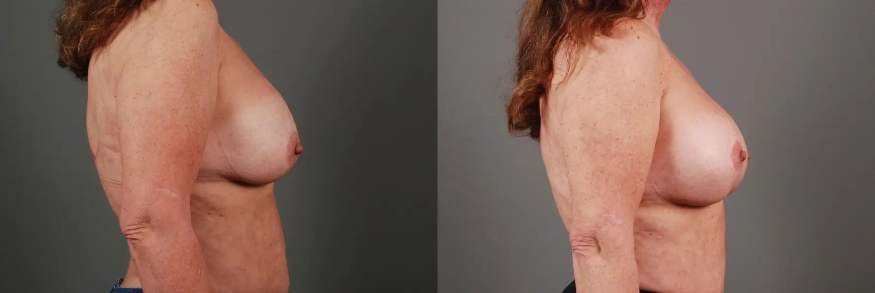Breast Implant Exchange: Patient 2 - Before and After 4