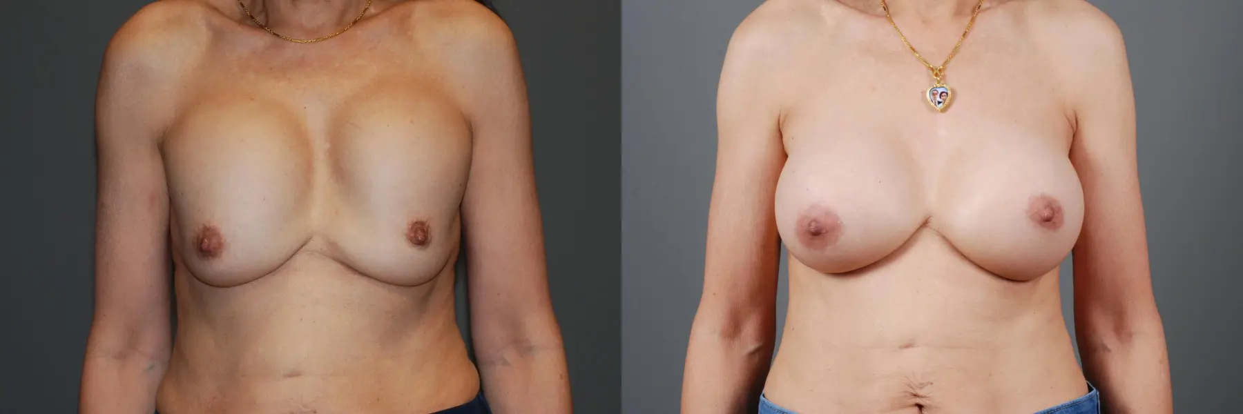 Breast Implant Exchange: Patient 7 - Before and After 1