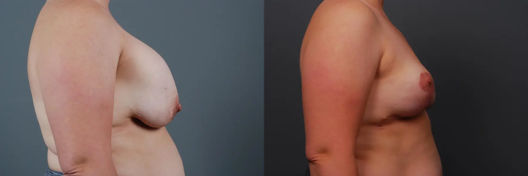 Breast Implant Exchange: Patient 6 - Before and After 3