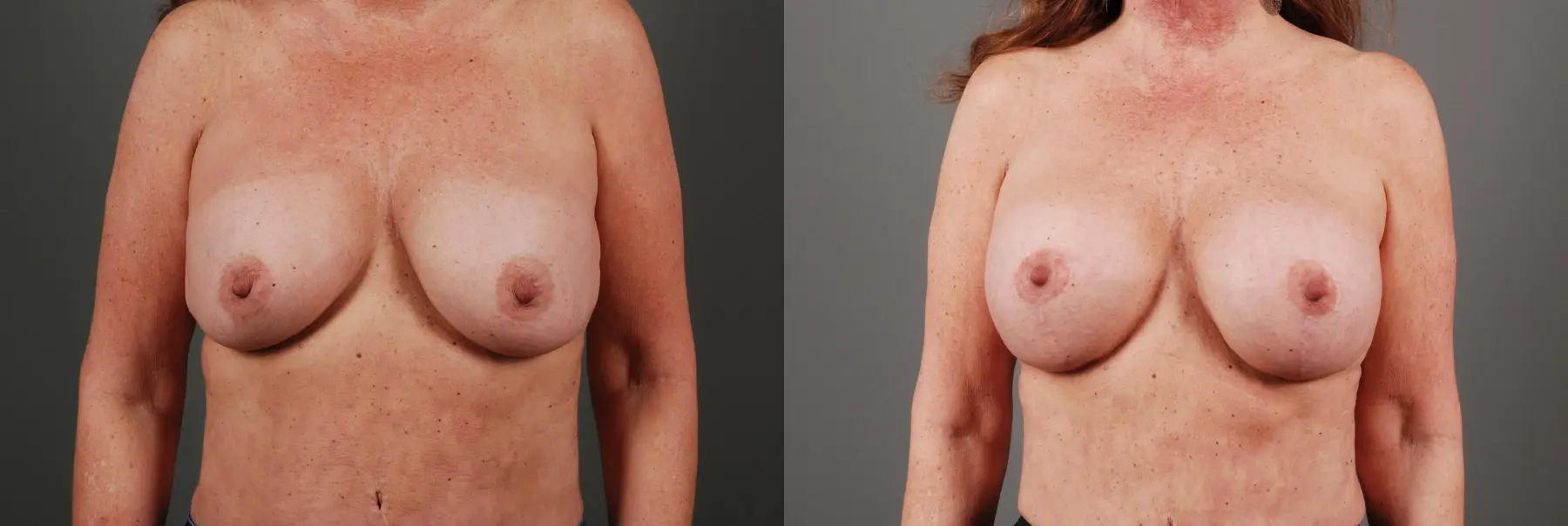 Breast Implant Exchange: Patient 2 - Before and After 1