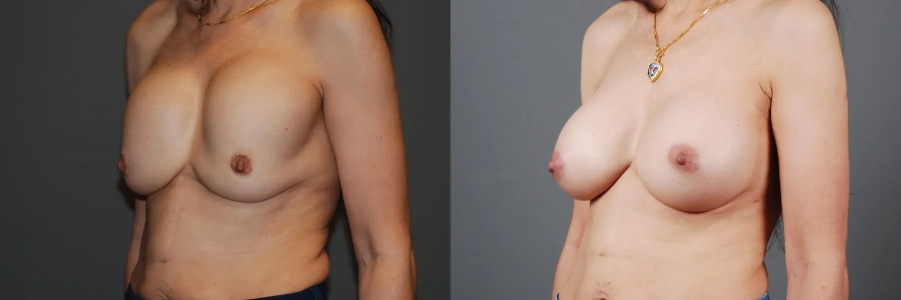 Breast Implant Exchange: Patient 7 - Before and After 4