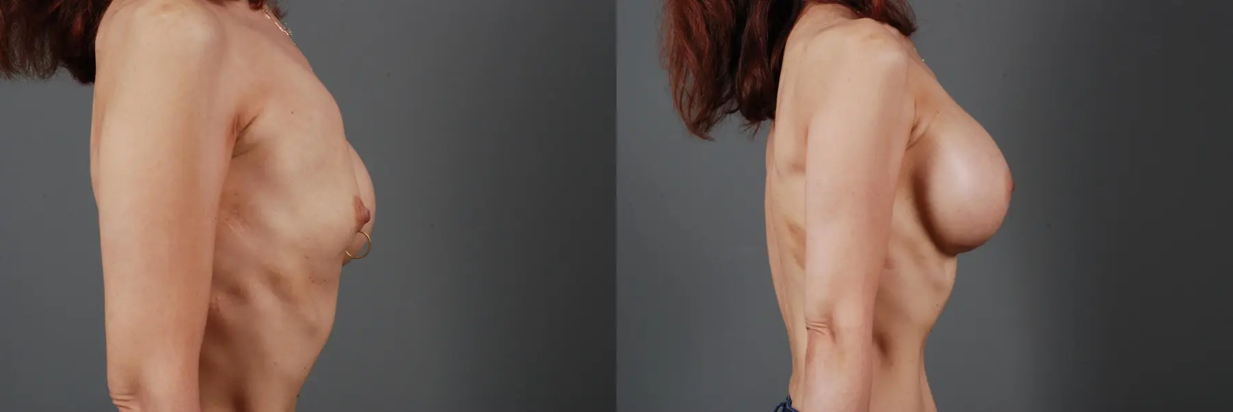 Breast Implant Exchange: Patient 4 - Before and After 5
